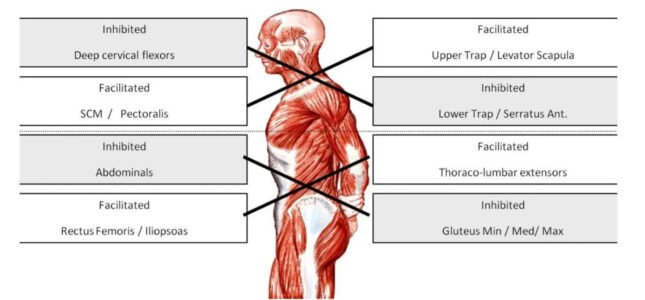 Muscles in the body showing where upper and lower crossed syndrome is