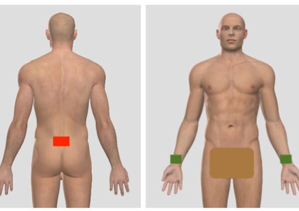 Male body with placement of Bioelectric Meridian Therapy (BMT) pads just above sacrum and carpal tunnel region.