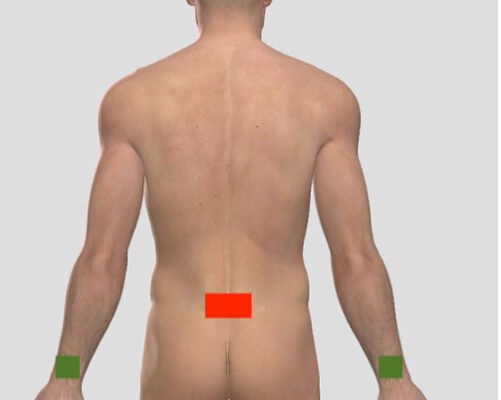 Male body with placement of BMT pads just above sacrum.