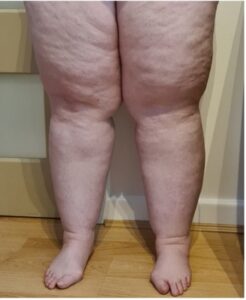Legs with Lipedema and Lymphedema from the front