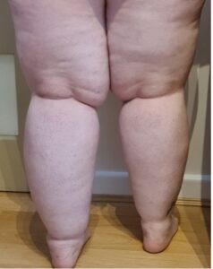 Legs with Lipedema and Lymphedema from the back