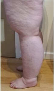 Legs with Lipedema and Lymphedema from the side