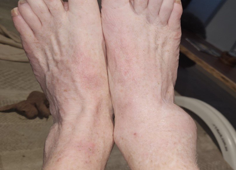 ankle sprain before and after using BMT PRO device